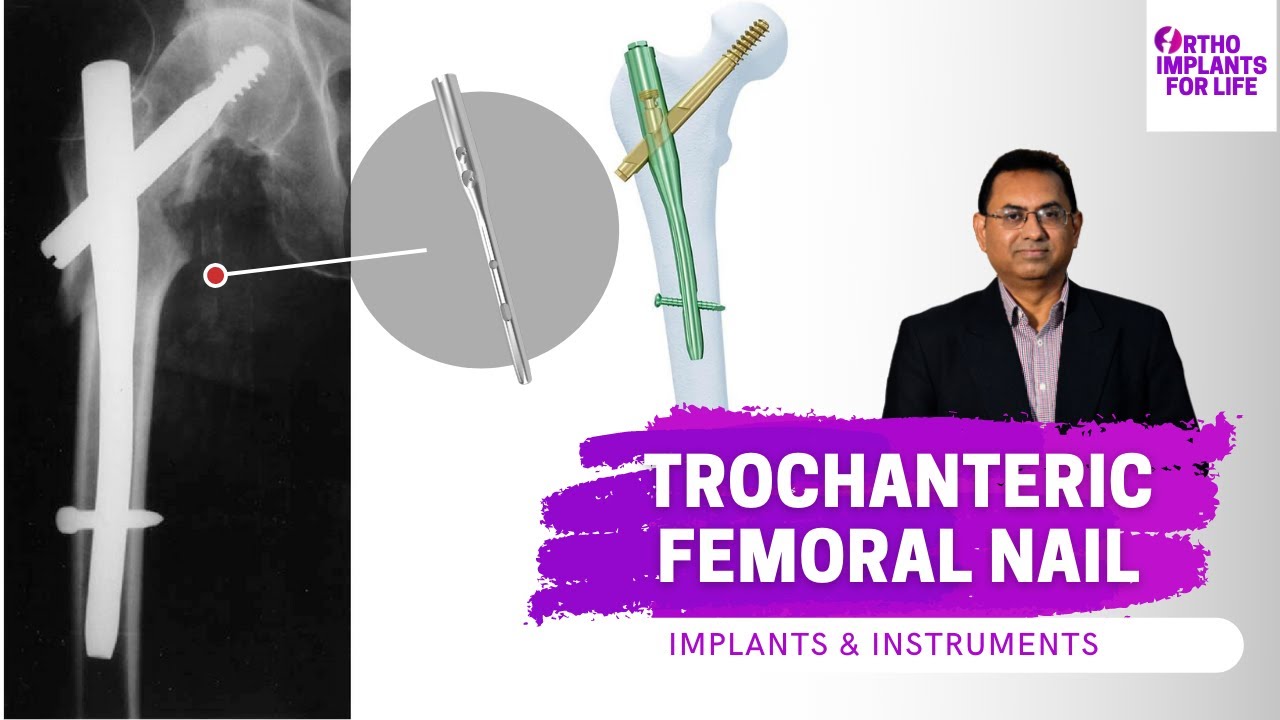 Trochanteric Femoral Nail | TFN | Implants And Instruments