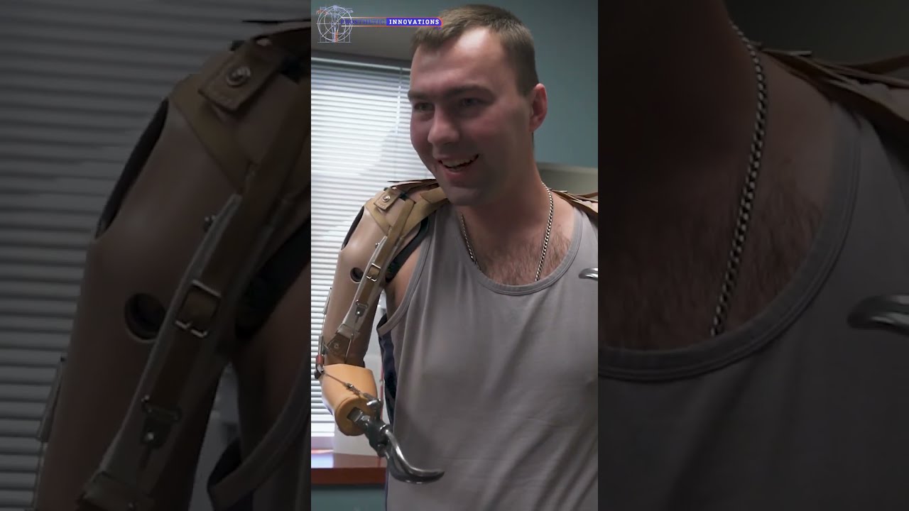 Short Bilateral Trans-Humeral Body Powered Prostheses | Prosthetic Innovations