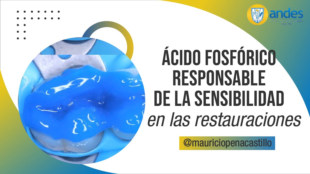 ¿Es el ácido fosfórico responsable de la sensibilidad en las restauraciones clase V?