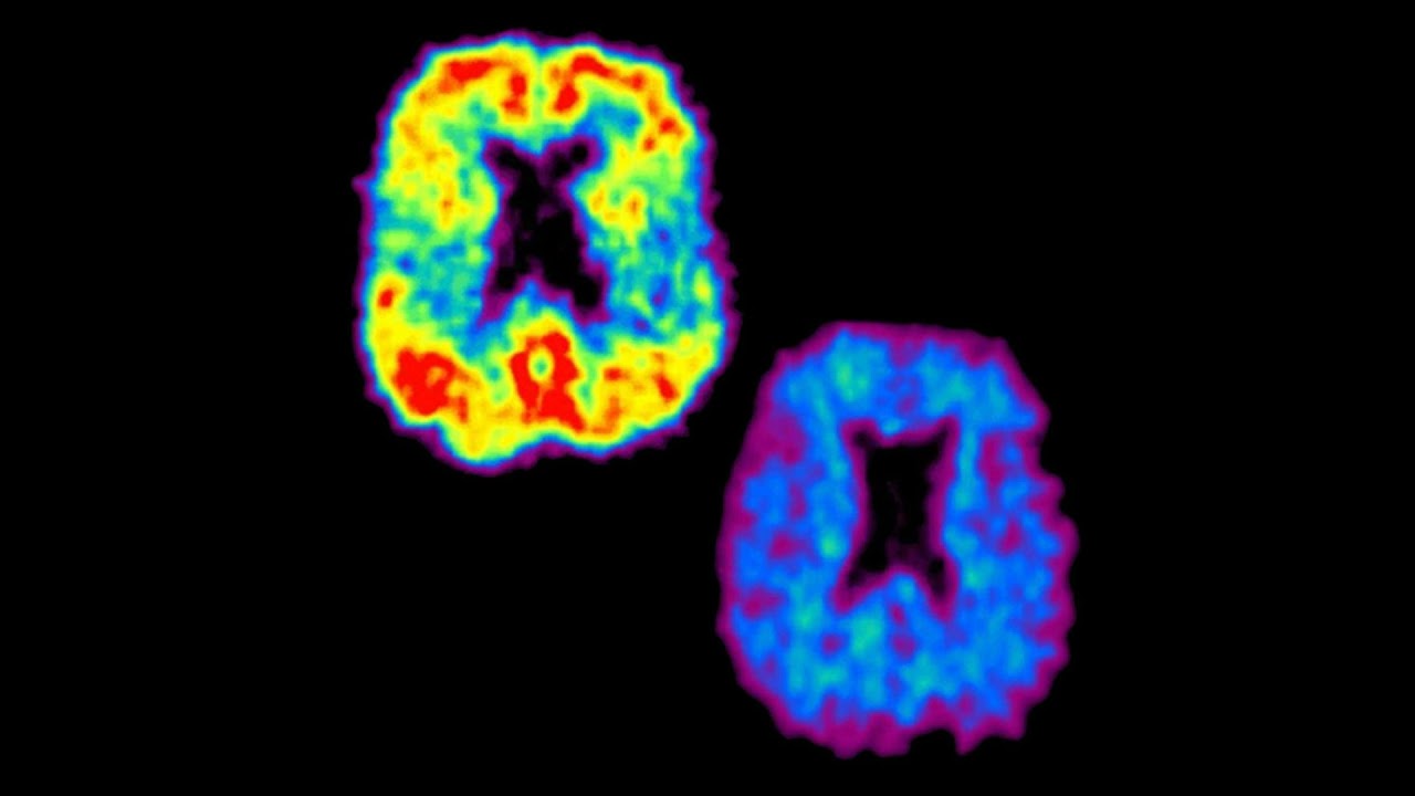 Ep138: Amyloid busters- the benefit and the burden