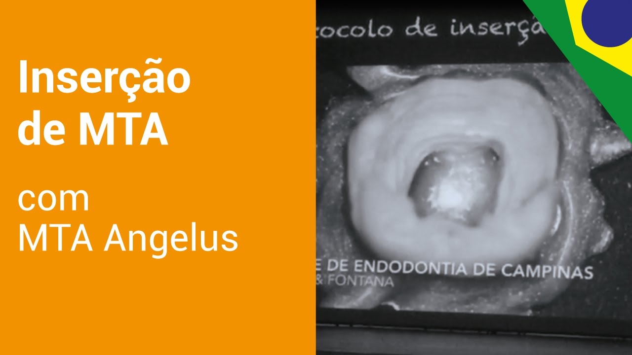 MTA Angelus | Protocolo de inserção do MTA