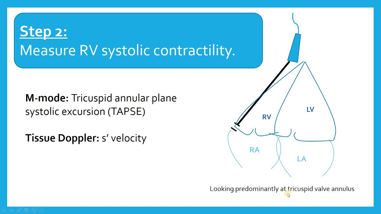 Critical Care Echo of the RV (Part 2) - Estimating RV size, systolic function, and systolic pressure
