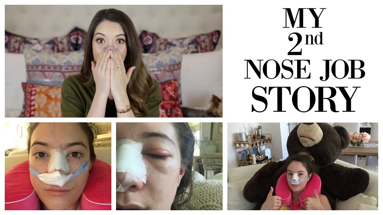 Why I Got Another Nose Job + My Revision Rhinoplasty Story | Blair Fowler