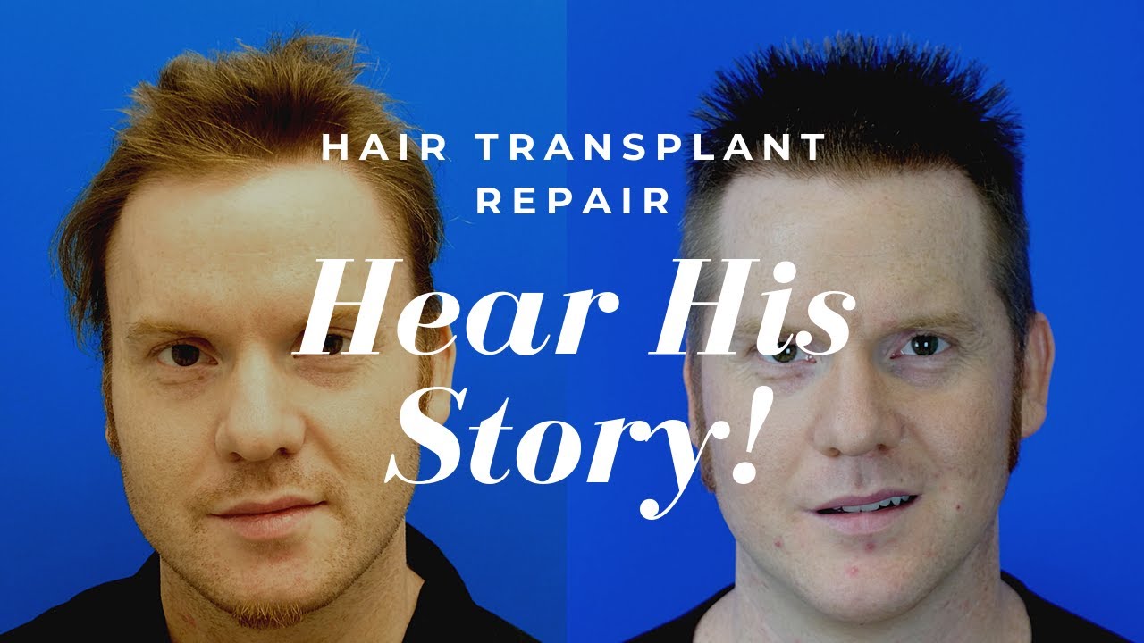 Hasson And Wong Reviews | 5,849 Grafts, Hair Transplant Repair & Hairline Reconstruction