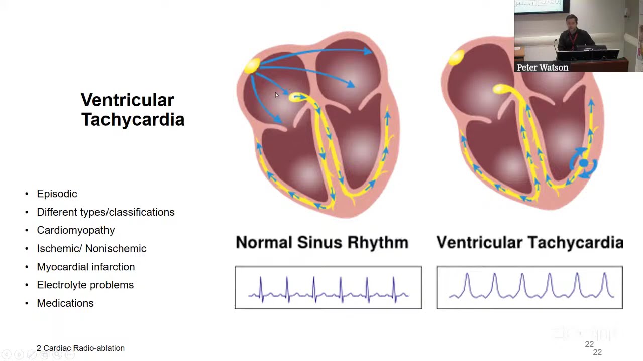 NSS 2024.12.13 Piotr Pater "Advancing Cardiac RadioAblation"