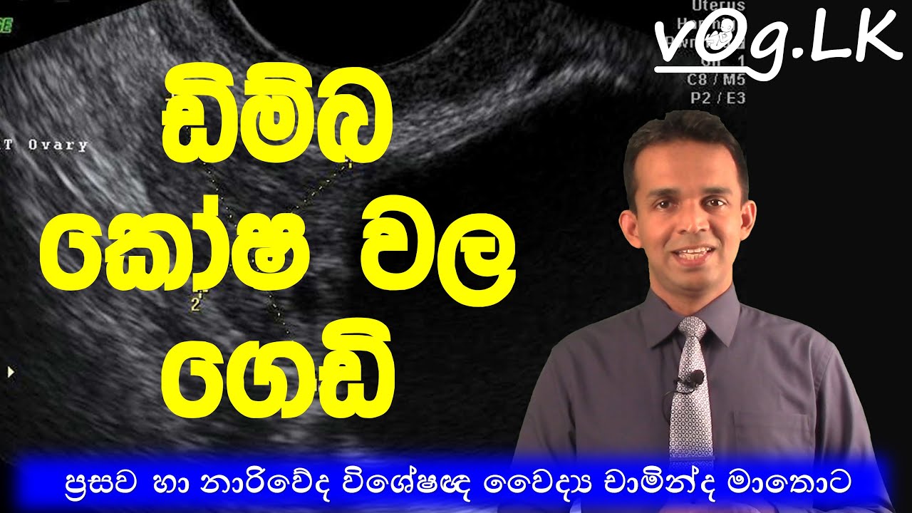 Ovarian cysts. ඩිම්බ කෝෂවල ගෙඩි