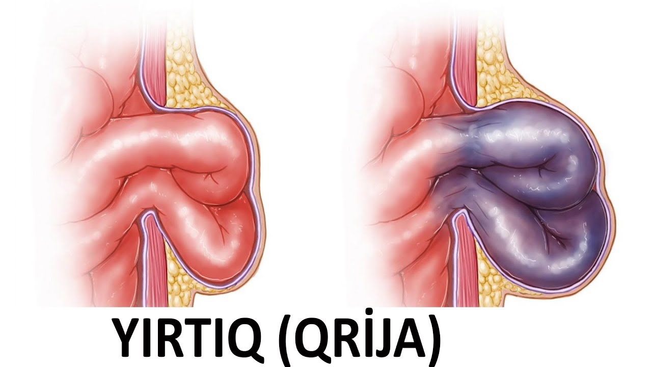 Hansı qrijalar (yırtıq) əməliyyat olunmalıdır?