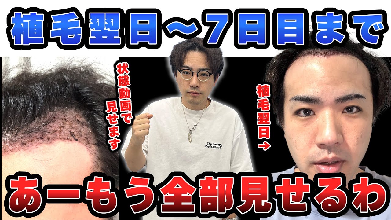 【ダウンタイム】2000グラフトで自毛植毛した男性の手術翌日から1週間後までの経過を大公開！！