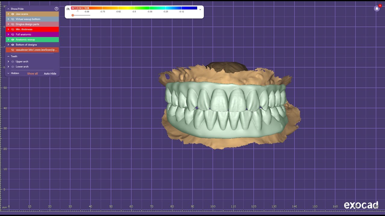Upper & lower full arch CADCAM designing for basal implant in Exocad