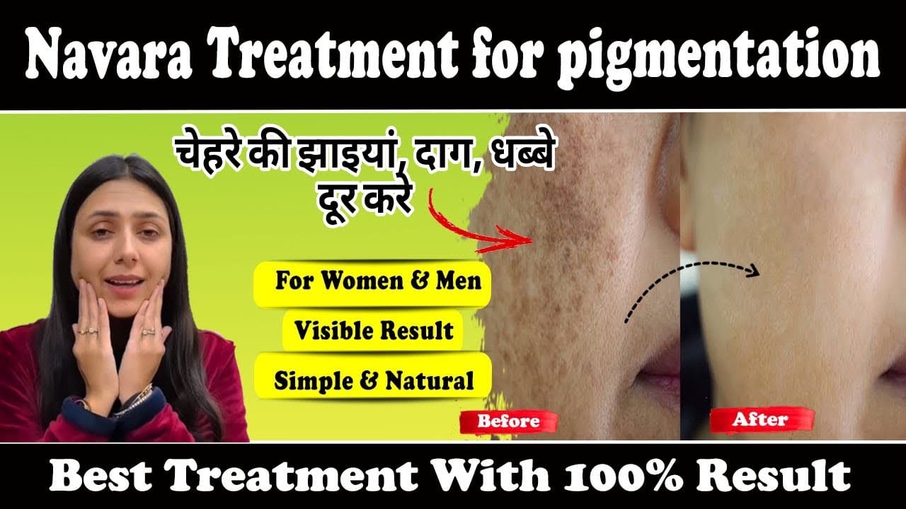 चेहरे की झाइयाँ, दाग धब्बे दूर करें | Navara treatment for Pigmentation | Jhaiyo ka ilaaj