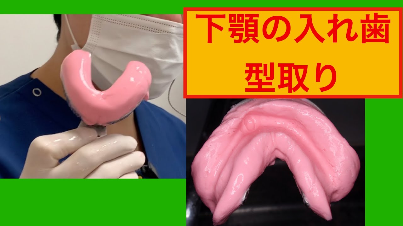 下顎の型取り　　総入れ歯の作成
