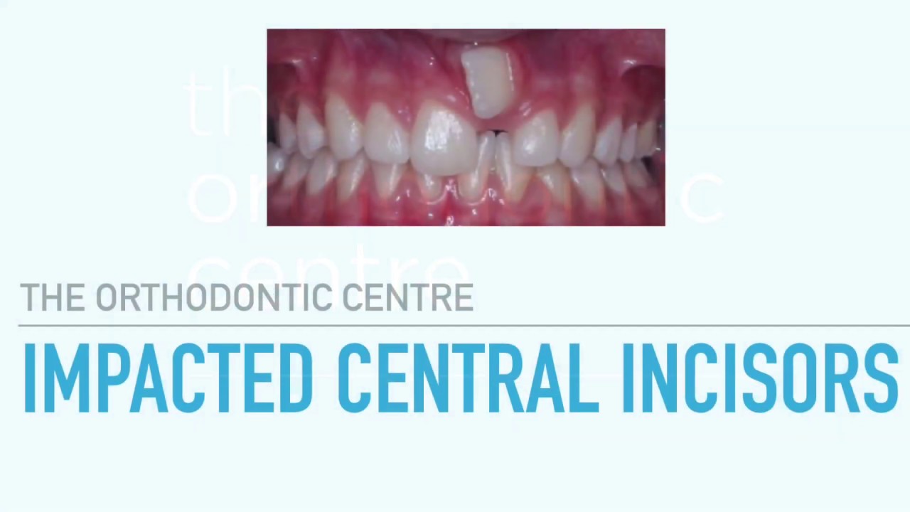 Impacted Central Incisors