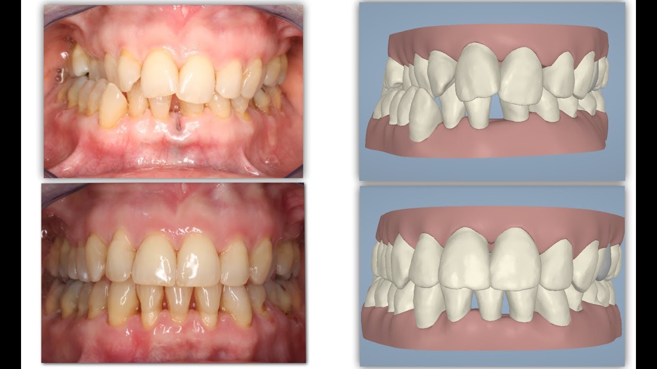 Amazing Invisalign Crossbite Orthodontic Treatment & incisor extraction (without braces)