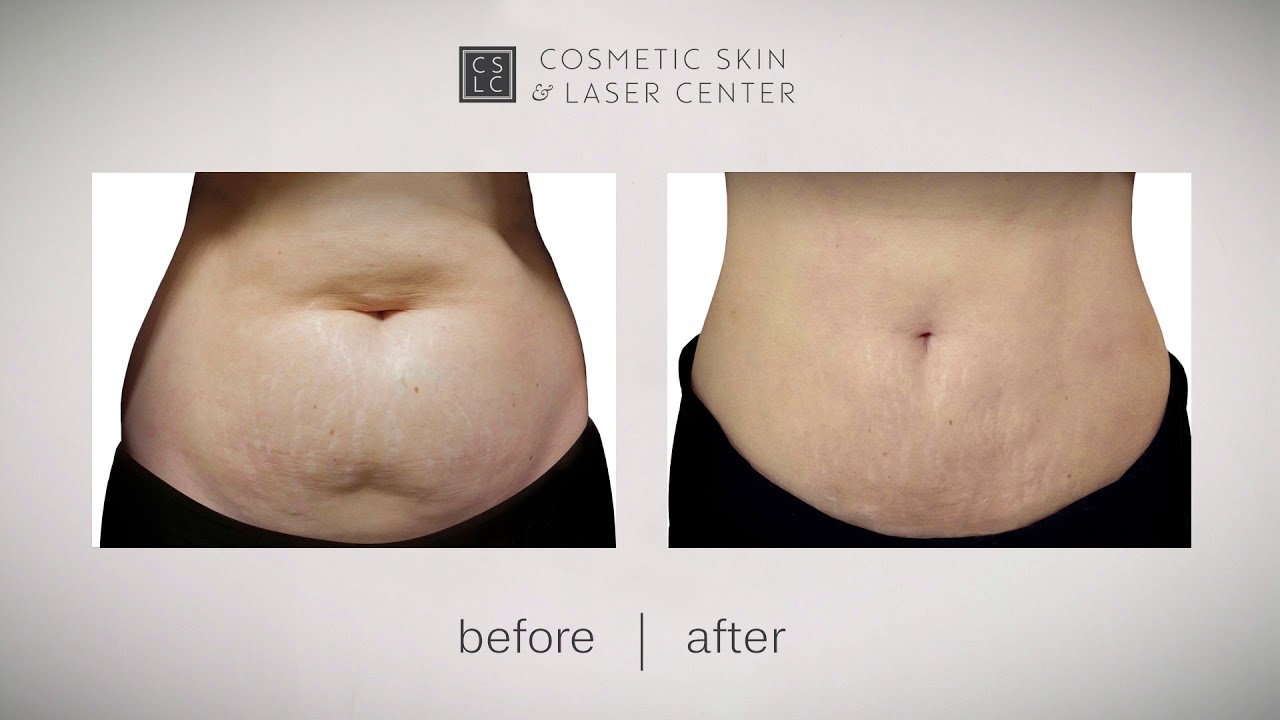 Smartlipo Basics