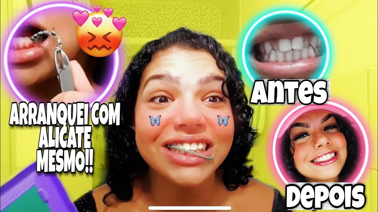 TIREI O APARELHO SOZINHA 🤣 *apanhei*