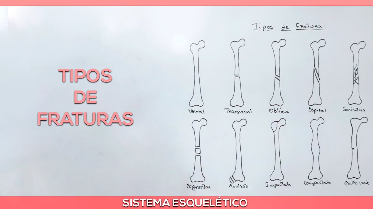 Tipos de fratura