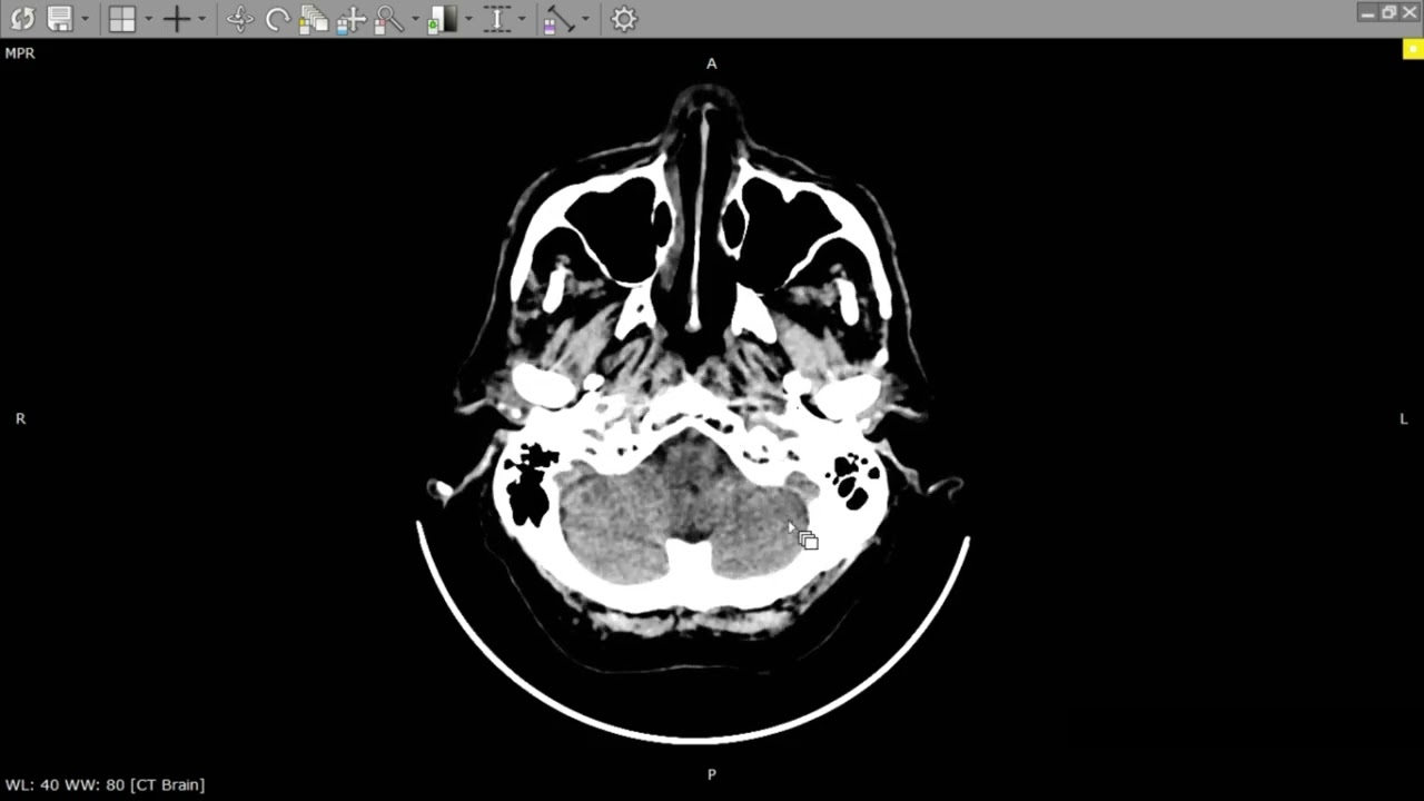 Anatomia do Encéfalo por tomografia