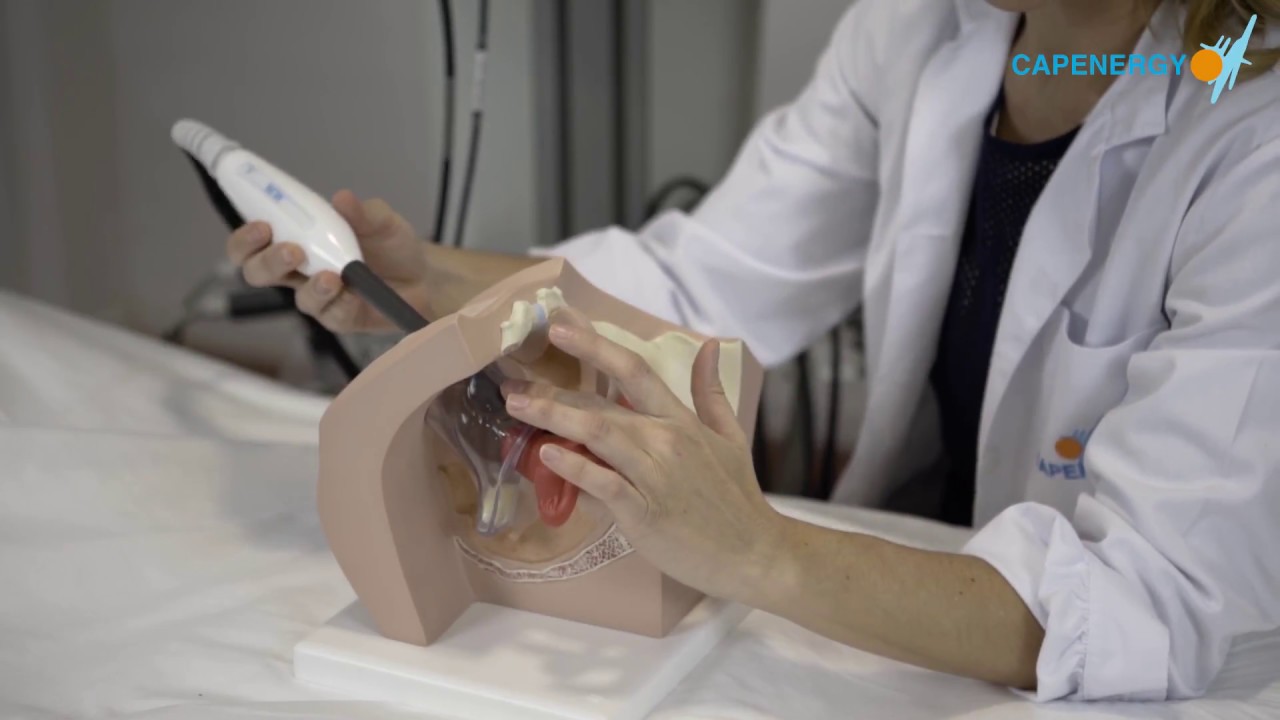 Suelo pélvico en paciente post-cancer