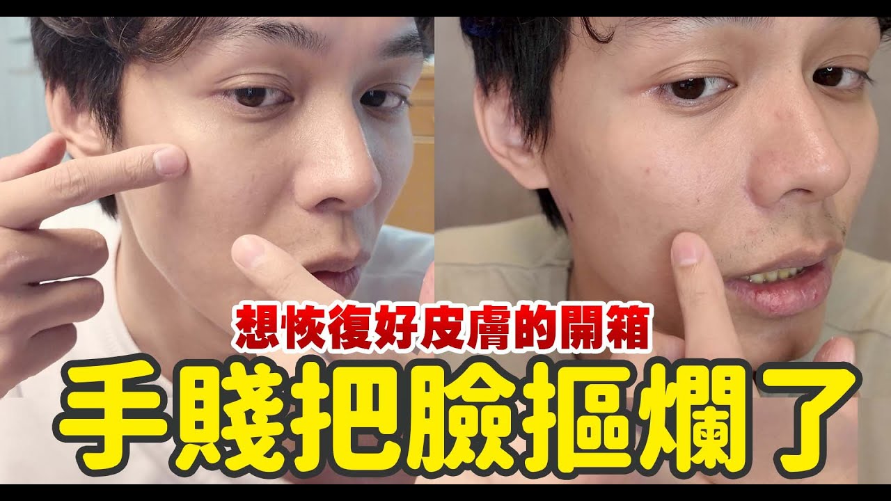 【開箱】手賤把臉摳爛了！？拯救爛臉鈞，開箱ULIKE美容儀！| 開箱找秉鈞 |