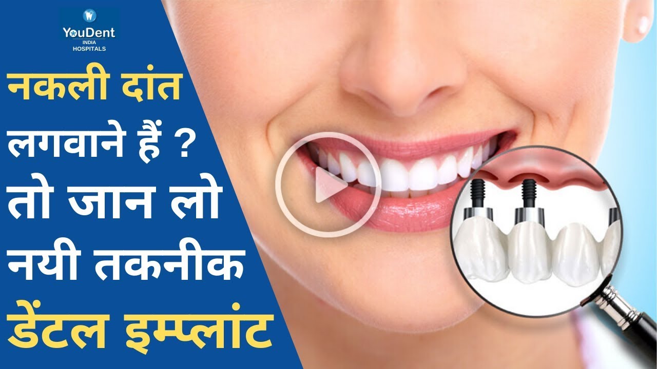 नकली दांत लगवाने से पहले ये वीडियो ज़रूर देख लेना | Dental Implant | Dental Care | V  03