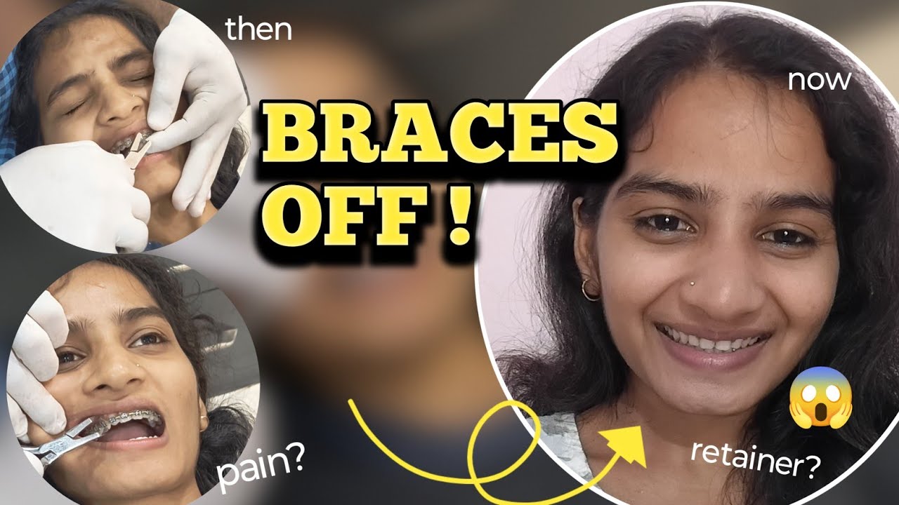 I Finally got my Braces off!  Retainer? Type?