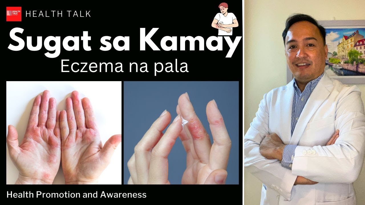 Eczema: Sugat sa kamay (Causes, Symptoms, Treatment and Prevention)