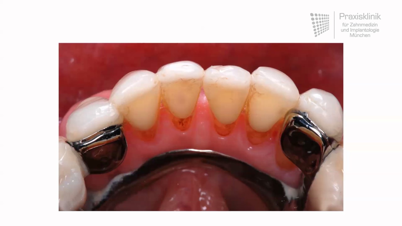 Replacing missing teeth: Different dentures and how they work