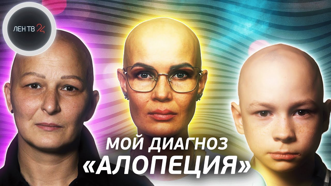 Что такое АЛОПЕЦИЯ? | Истории людей о жизни без волос | Страна лысых
