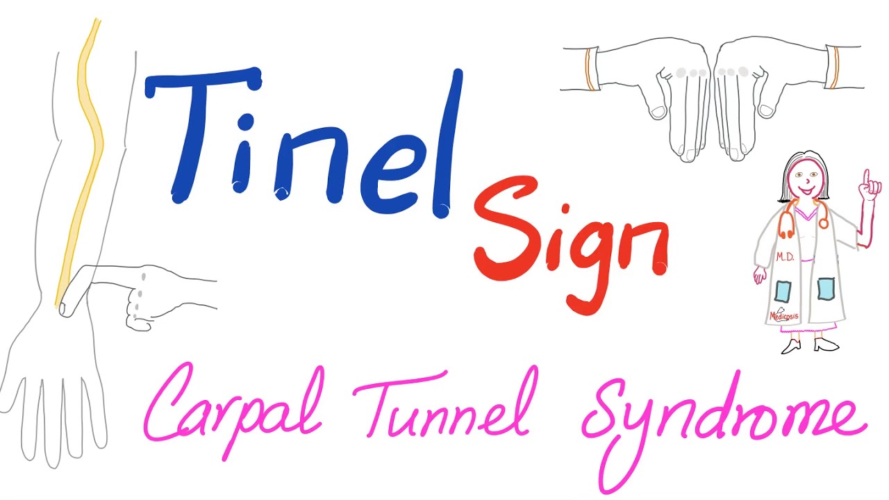 Tinel Sign | Carpal Tunnel Syndrome