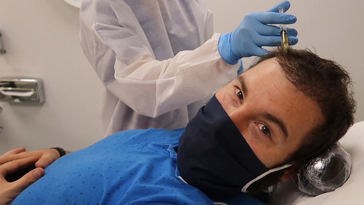 1ª Sesión de PLASMA RICO EN PLAQUETAS tras mi 2º TRASPLANTE CAPILAR - PRP CAPILAR