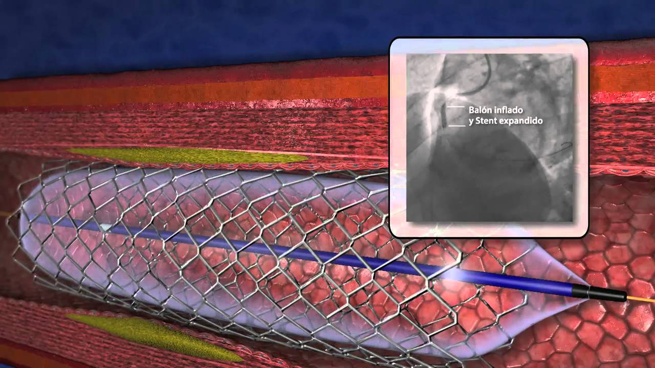 Angioplastia coronaria
