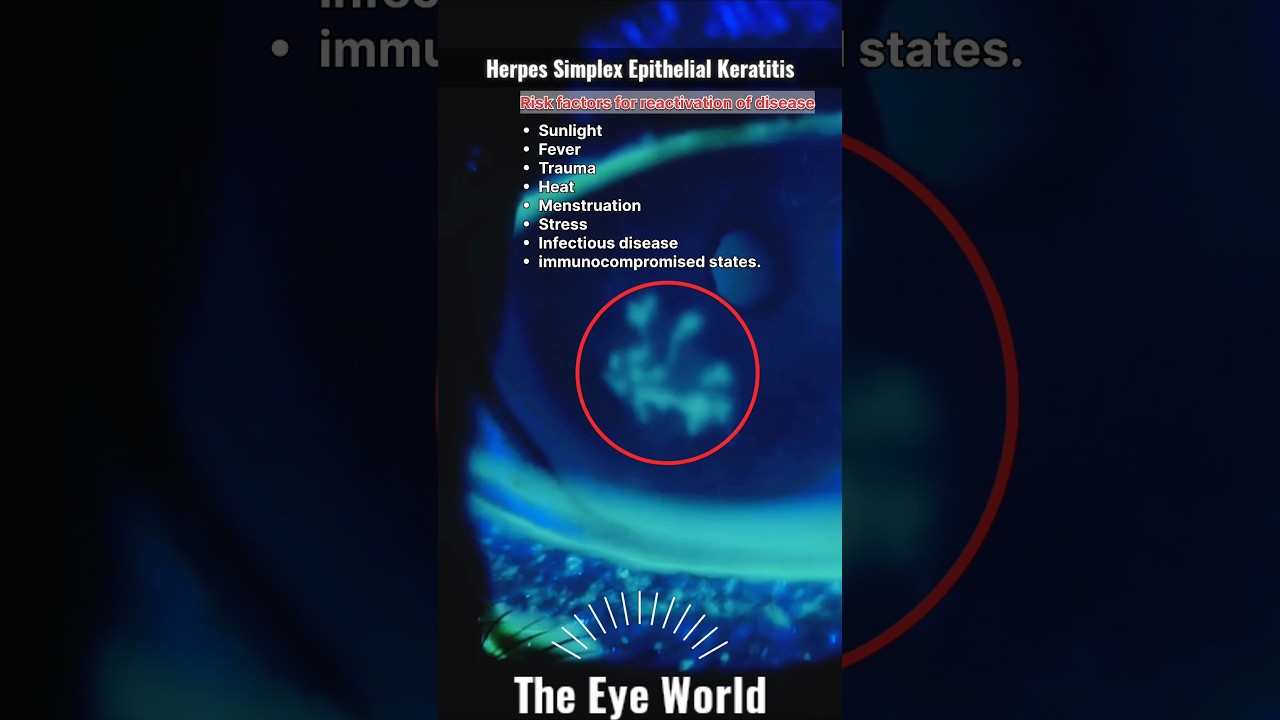 Herpes Simplex Epithelial Keratitis #cornea #eyes