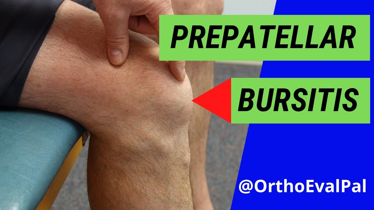 Prepatellar Bursitis (Anterior knee pain and swelling)
