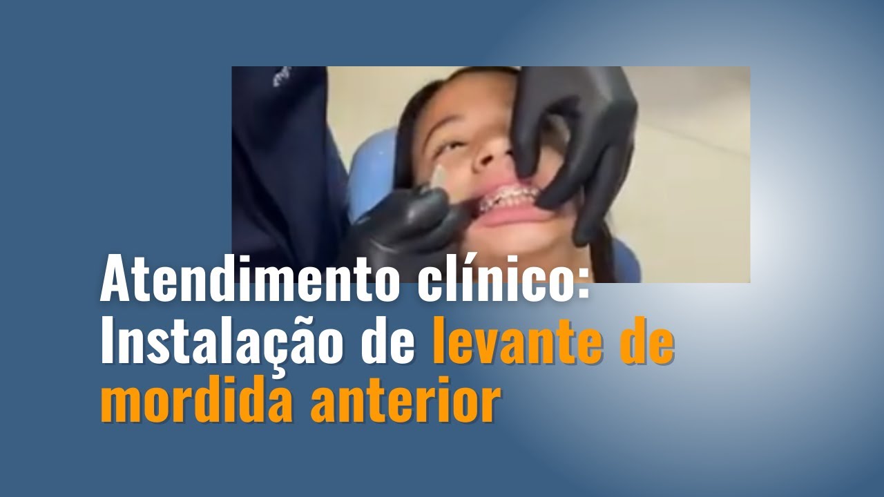 Atendimento clínico: Instalação de levante de mordida anterior - Daniel Salles