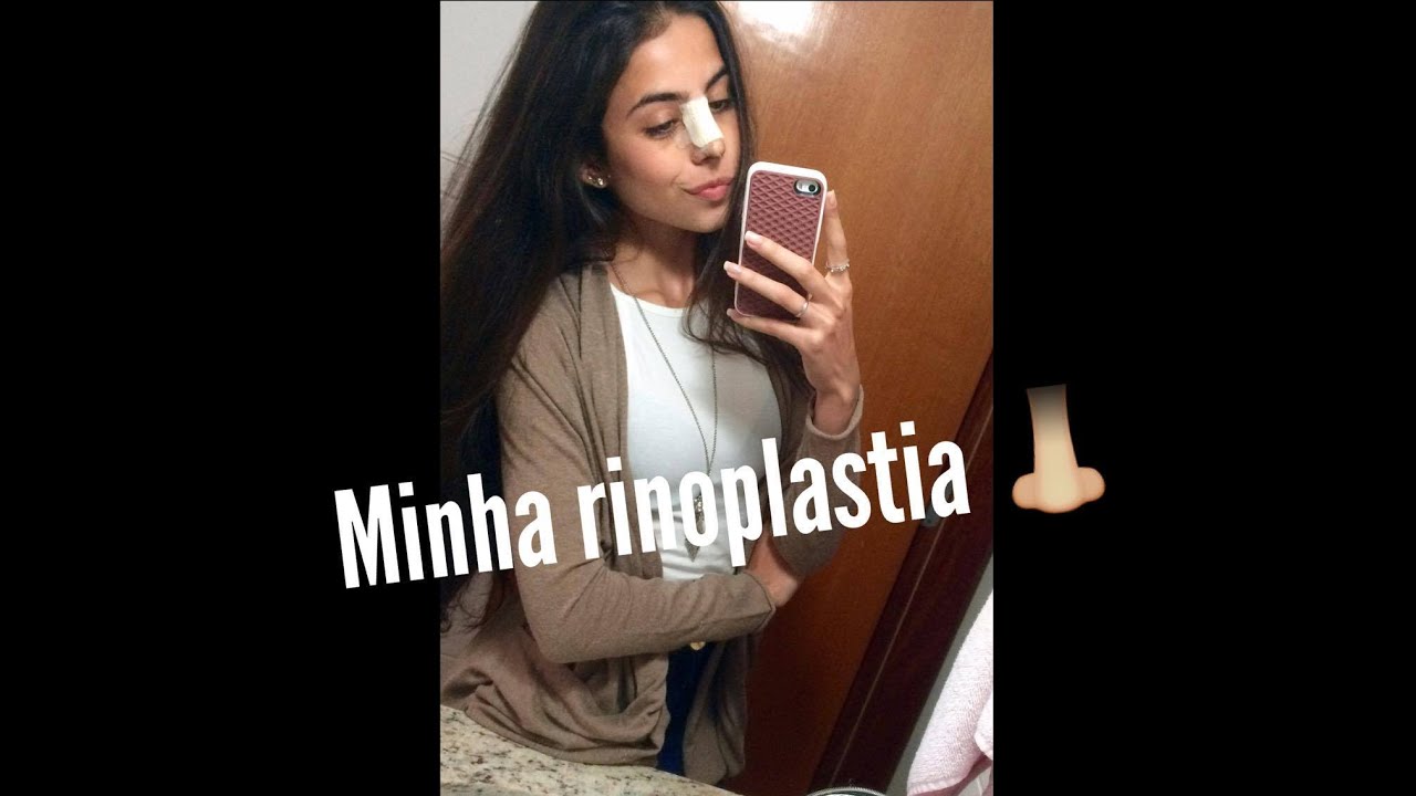 MINHA RINOPLASTIA - SEPTOPLASTIA (+ fotos)