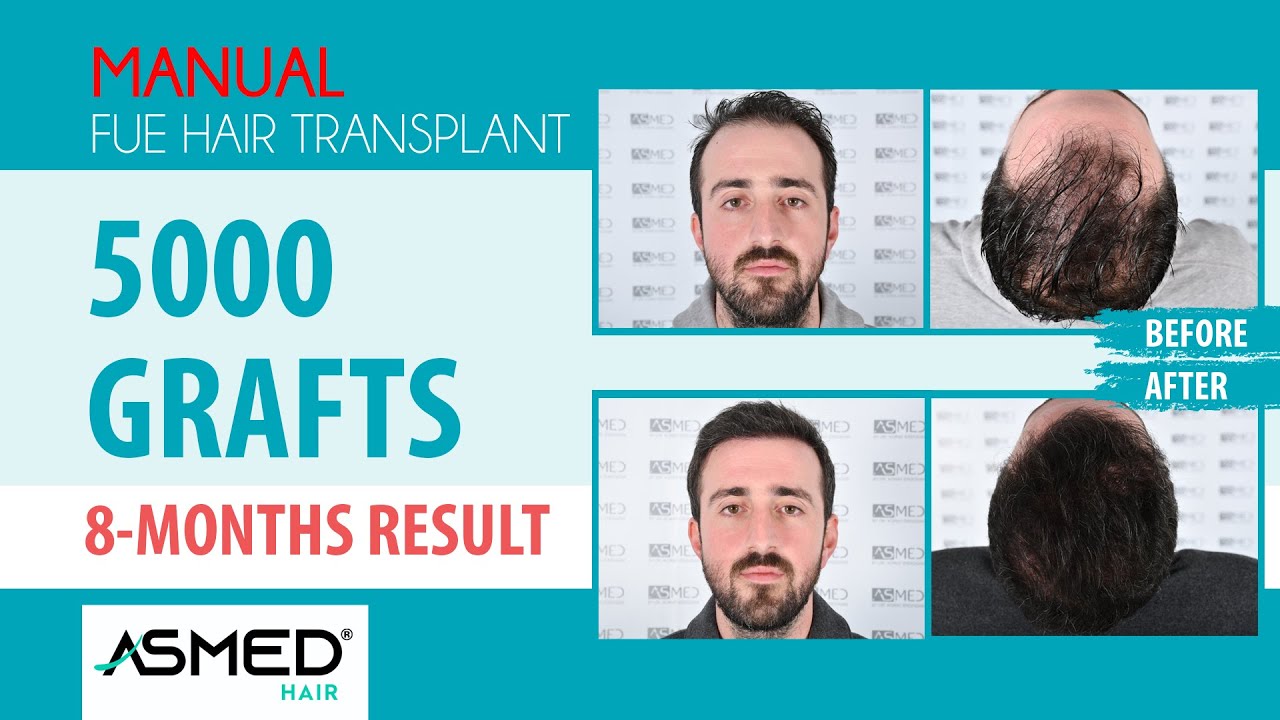Manual FUE Saç Ekimi 5000 Greft 8 Aylık Sonuç #hairtransplant  #asmed