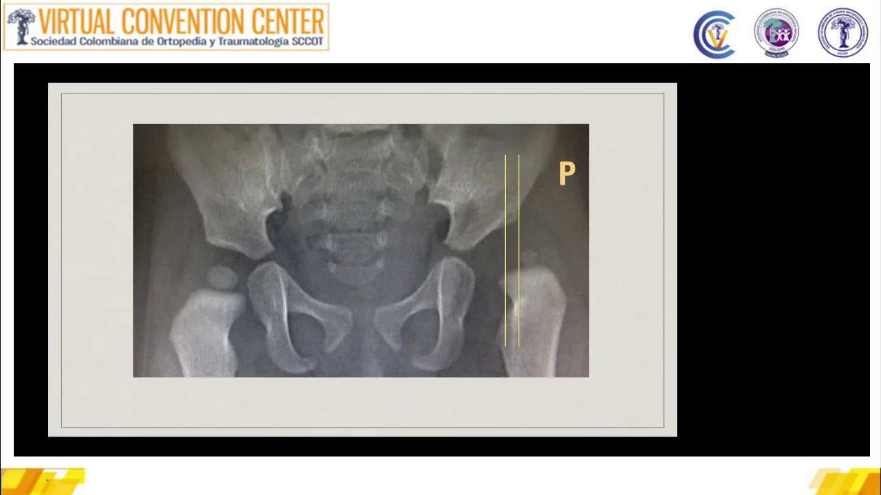 Webinar Radiología de la displasia de cadera, un dolor de cabeza