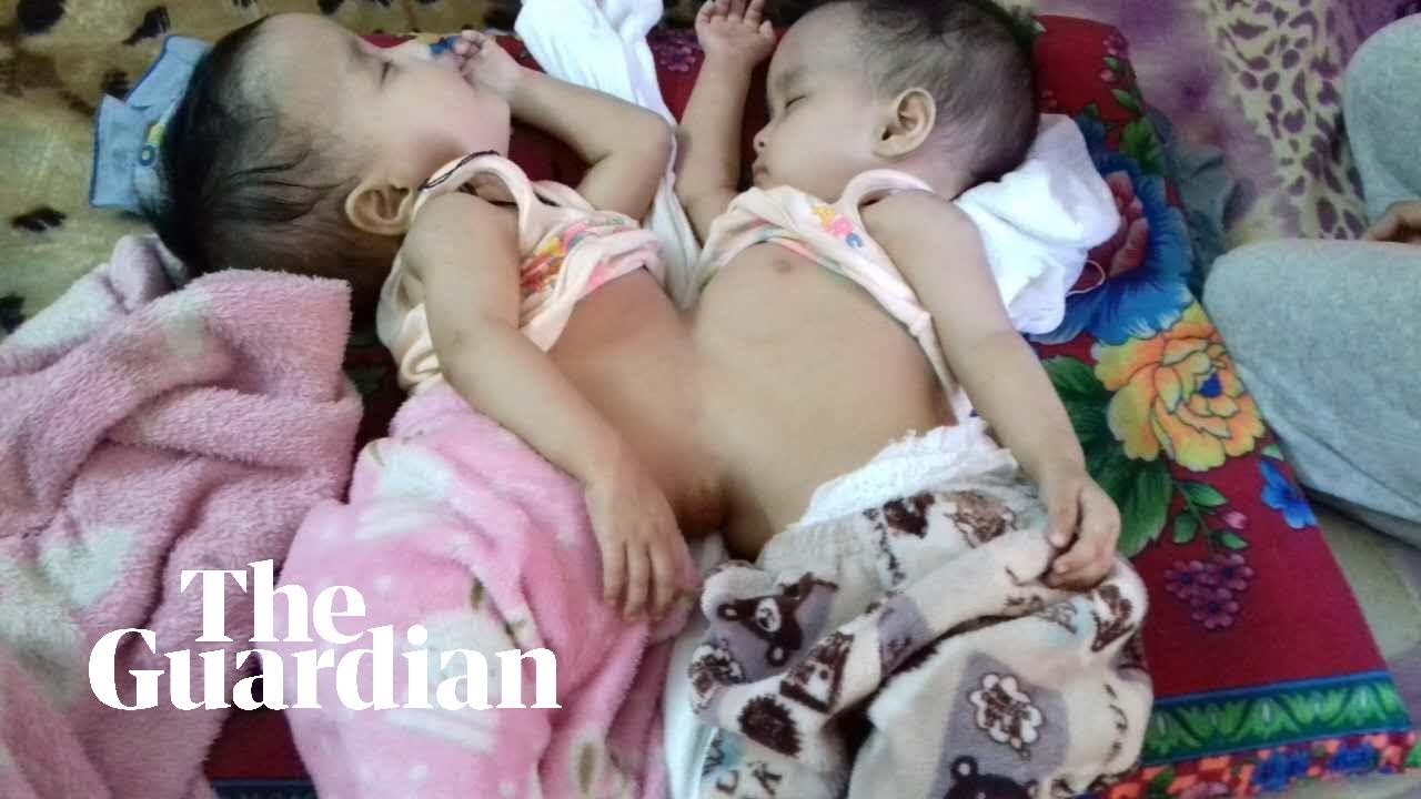 Bhutanese conjoined twins to be separated at Melbourne hospital