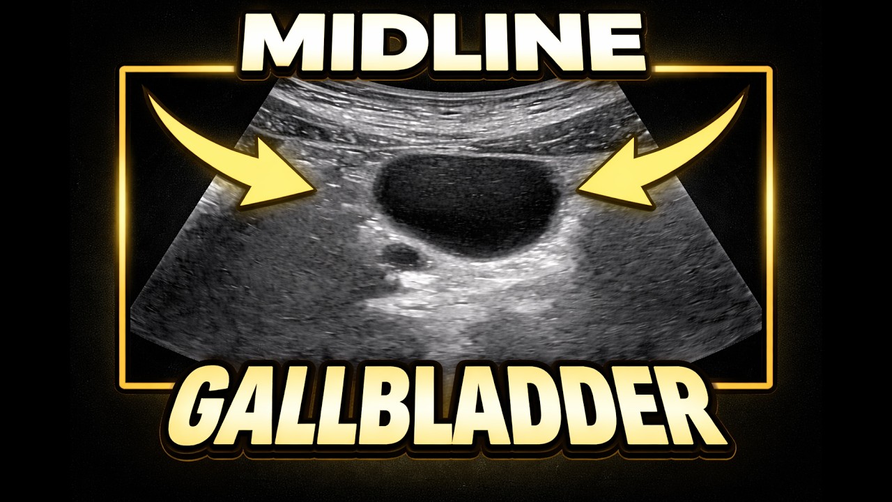 Midline Gallbladder (Ultrasound Case)