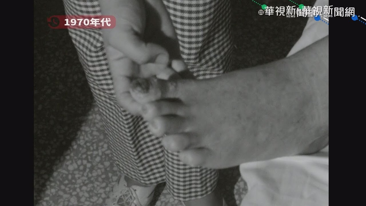 【16釐米膠卷】台灣人60年前的痛...「烏腳病」實紀衝擊重現