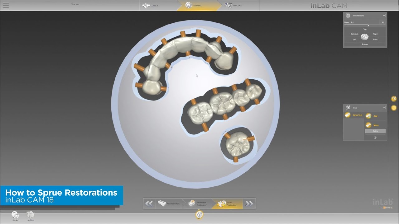 inLab CAM 18: How to Sprue Restorations