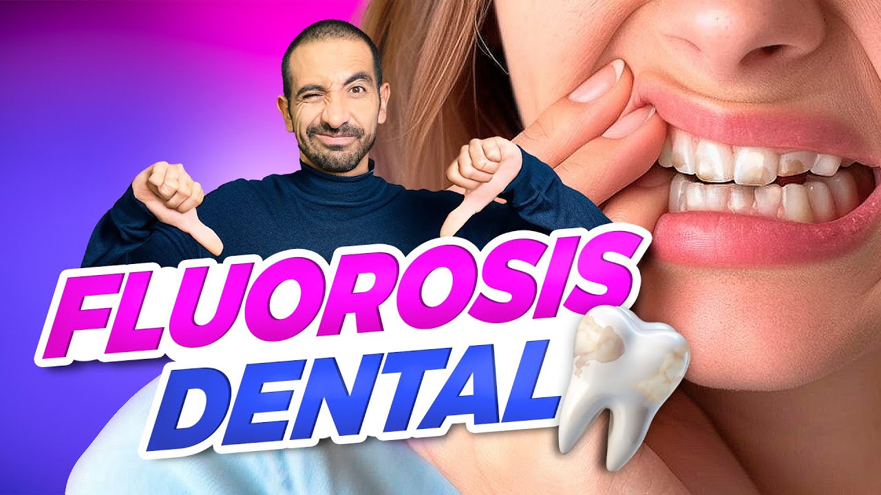 Cómo Quitar las Manchas en los Dientes. CASO DE ÉXITO. Fluorosis dental.
