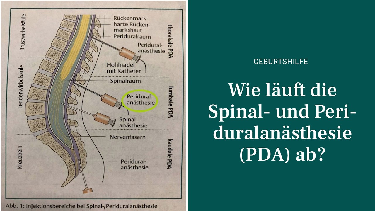 PDA: Schmerzarme Geburt in der Privatklinik Döbling