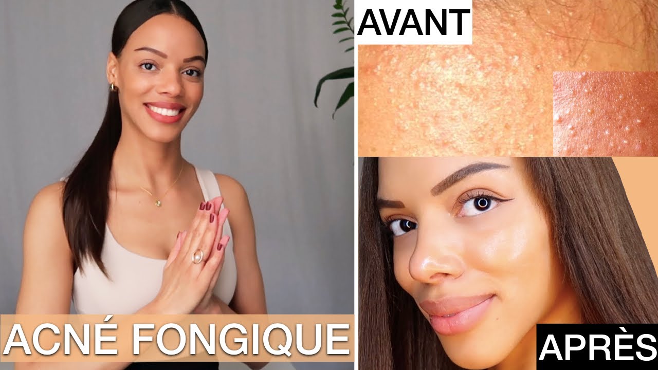 S.O.S: Peau Granuleuse/Rugueuse: Acné Fongique | Routine Tous Types de Peau pour s'en Débarrasser !