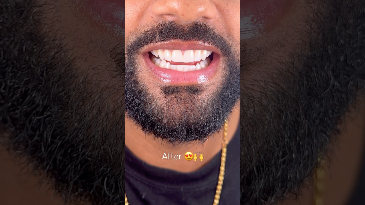 Before vs After Invisalign and composite by Dr. Josh #dentalbonding #viral