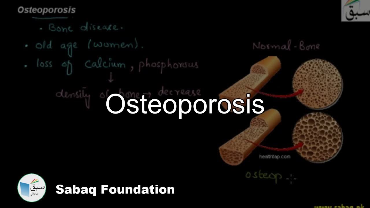 Osteoporosis, Biology Lecture | Sabaq.pk