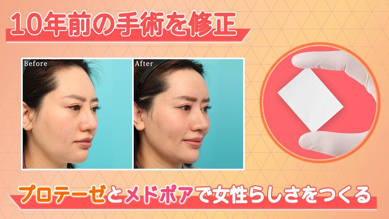（手術シーン無し）【額の修正手術】プロテーゼとメドポアで女性らしさをつくる｜ヴェリテクリニック