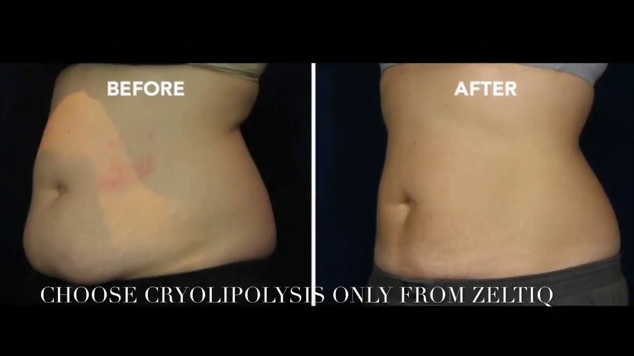 Coolsculpting by ZELTIQ
