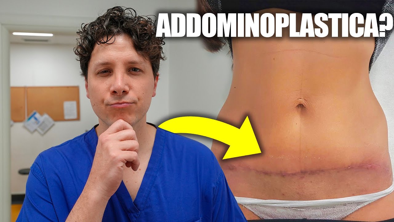 Addominoplastica: Quando si vedono DAVVERO i risultati?