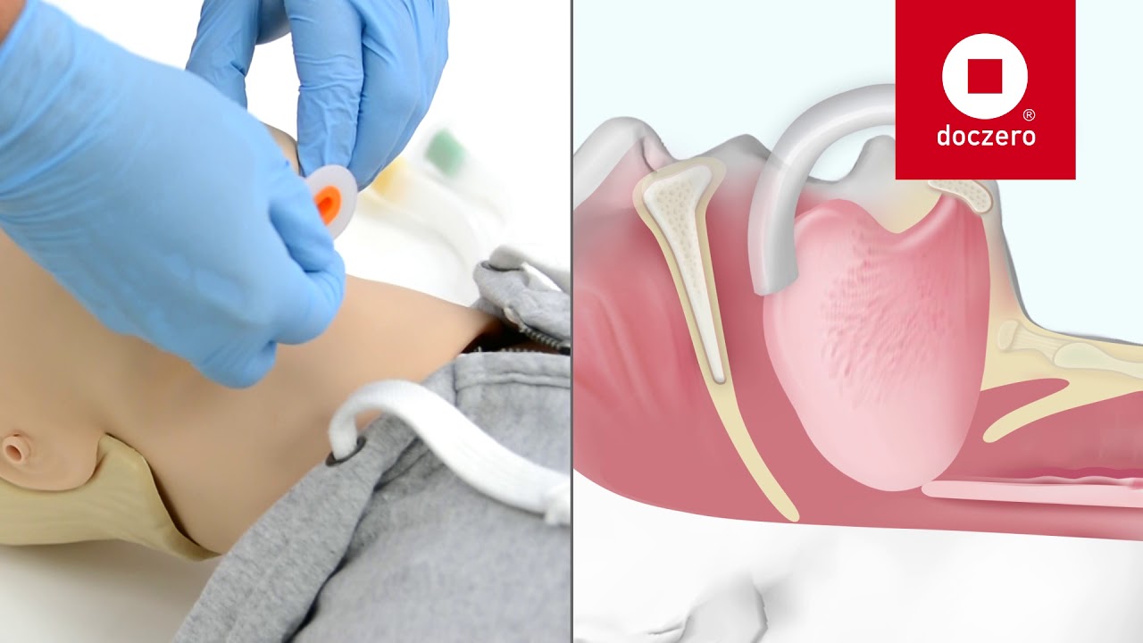 Oropharyngeal Airway inbrengen | Doczero E-learning